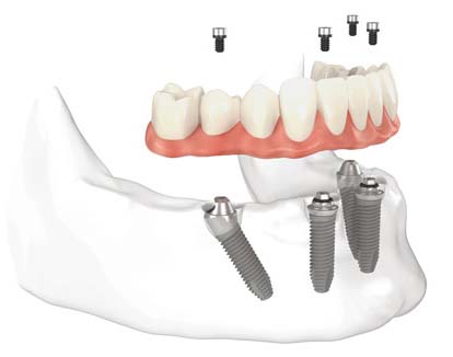 full arch dental implants model miami beach fl