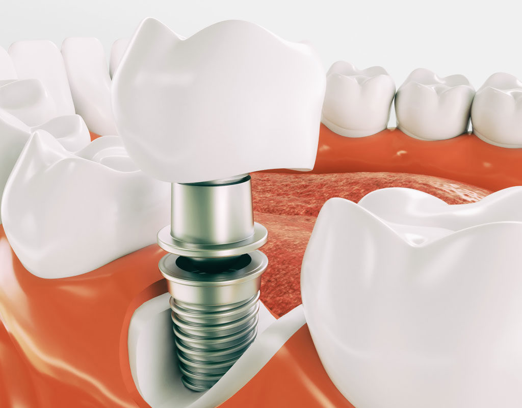dental implant model in color