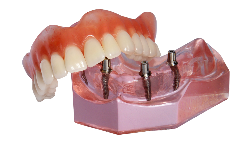 implant supported denture model