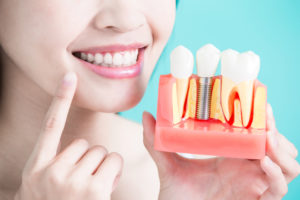 The Ever-So Popular Dental Implants