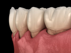 gum recession