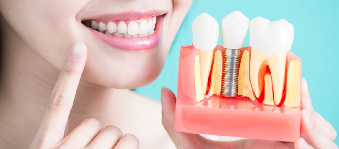 The Ever-So Popular Dental Implants